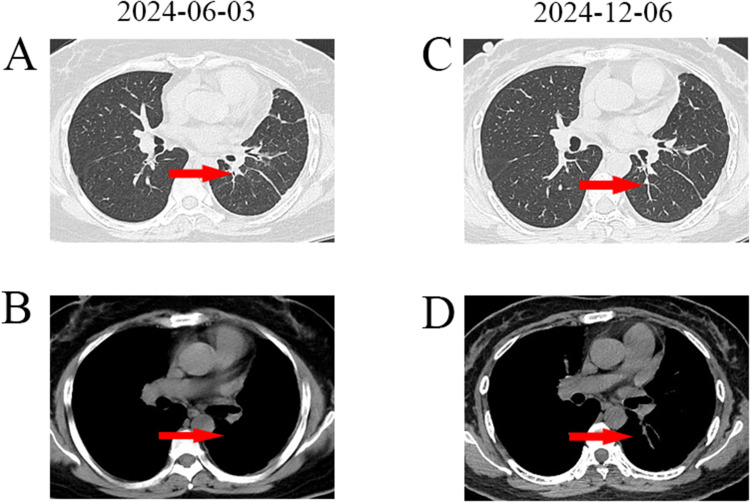 Combination of Aumolertinib, Dabrafenib, and Trametinib for a Patient with Advanced Lung Adenocarcinoma with an Osimertinib-Induced BRAF V600E Mutation: A Case Report.