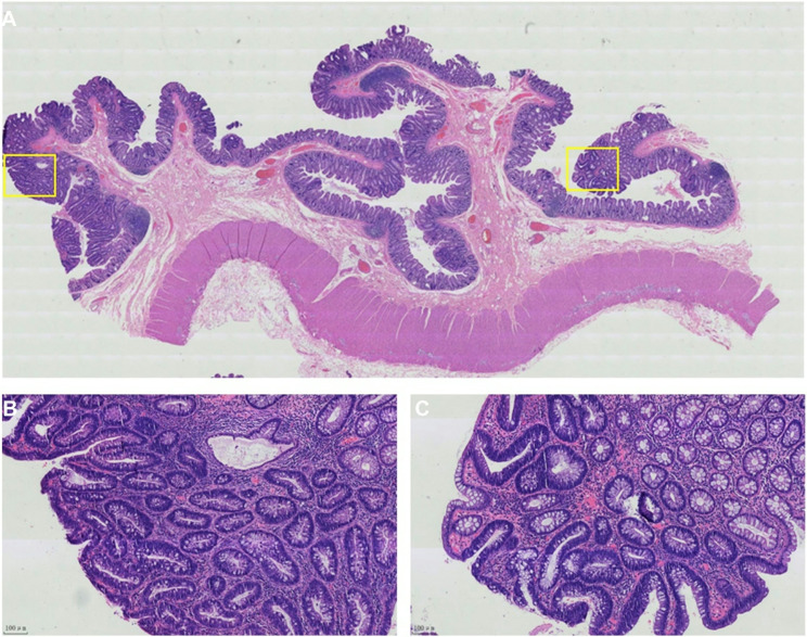 Family adenomatous polyposis come across dome type adenocarcinoma: a case report and literature review.