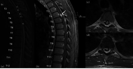 Acute Myelopathy as Initial Presentation of Disseminated Histoplasmosis: A Case Report.