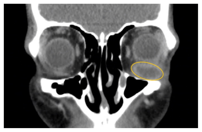 A Case Report of Inferior Rectus Abscess.