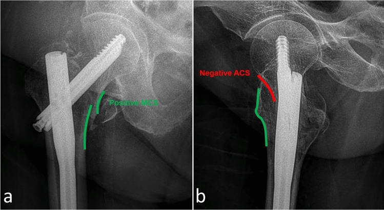 Predicting mechanical complications in proximal femoral nailing for elderly patients: a radiological scoring system based on a single-centre retrospective cohort with 586 cases.