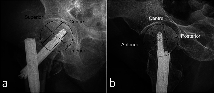 Predicting mechanical complications in proximal femoral nailing for elderly patients: a radiological scoring system based on a single-centre retrospective cohort with 586 cases.