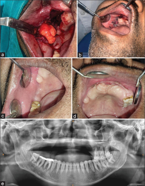 Actinomycotic Osteomyelitis in the Maxilla: A Rare Case Report of Postdengue Complication in Diabetic Patients.