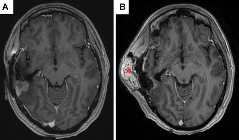 <b>Recurrent Glioblastoma Resection with Microvascular Free Flap Reconstruction and Associated GammaTile Implantation: A Personalized Approach with Oncologic and Reconstructive Integration</b>.