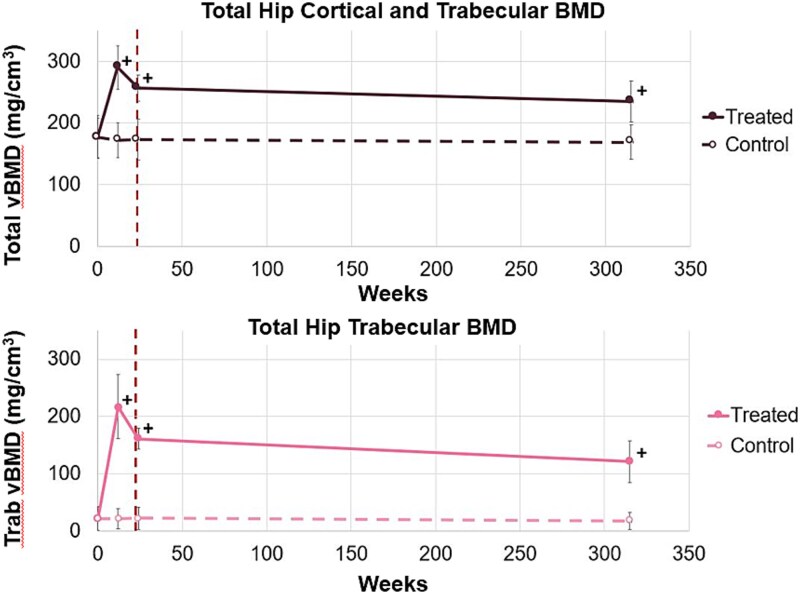 AGN1 local osteo-enhancement procedure increases proximal femur volumetric bone mineral density of women with post-menopausal osteoporosis as assessed by quantitative computed tomography analysis.