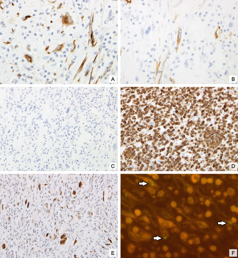 From benign appearance to malignant truth: a case report of mesenteric dedifferentiated liposarcoma with inflammatory myofibroblastic tumor-like features.