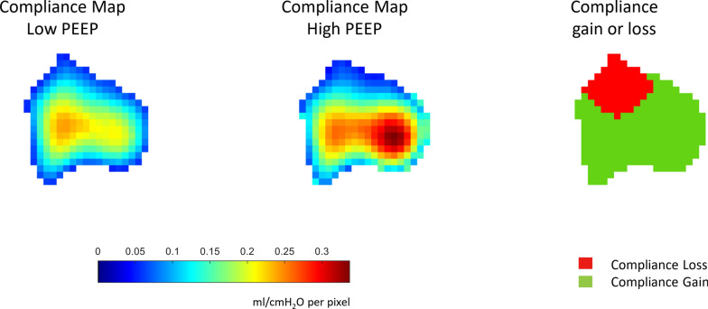 Intracranial response to positive end-expiratory pressure is influenced by lung recruitability and gas distribution during mechanical ventilation in acute brain injury patients: a proof-of-concept physiological study.
