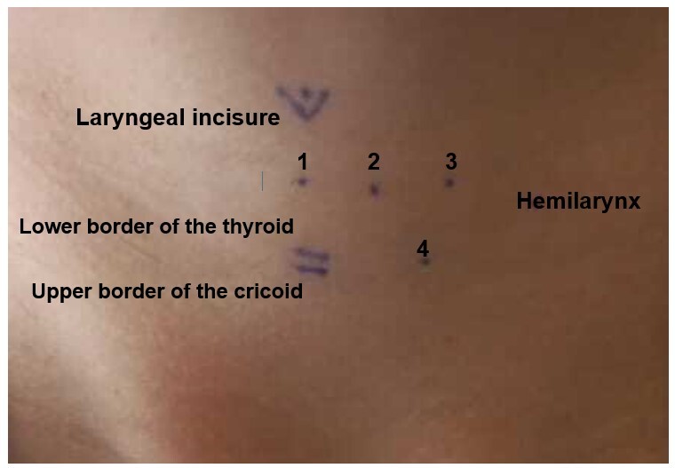 Immediate effects of photobiomodulation with low-level laser in women with no laryngeal or voice changes: preliminary results.