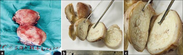 Cervical Lymphangiolipoleiomyoma: An Unusual Offender at a Usual Destination - Case Report and Literature Review.