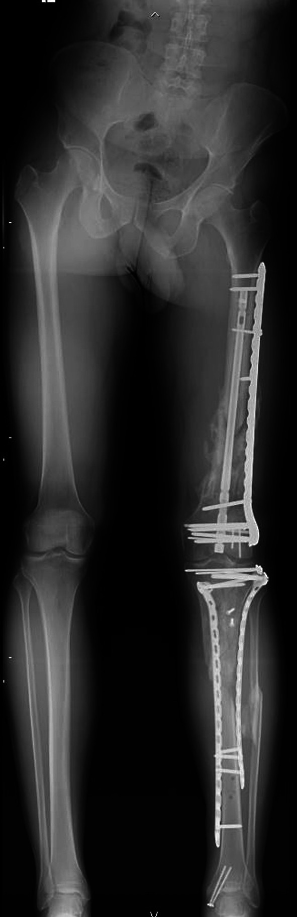 Double plating versus nail-plate construct in AO 33C distal femur fractures: treatment choice affects knee alignment, clinical outcomes, and quality of life-a multicenter study.