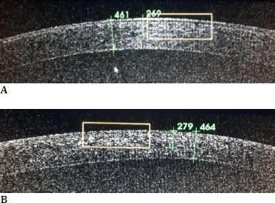 Standard and accelerated crosslinking protocols in keratoconus - differences and evolution at one year.