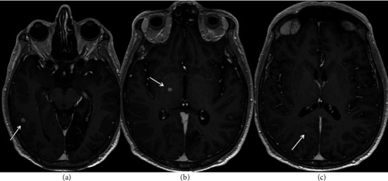 Acute Myelopathy as Initial Presentation of Disseminated Histoplasmosis: A Case Report.