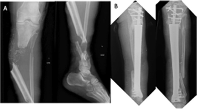 The expanding role of additive manufacturing in orthopaedic traumatology.
