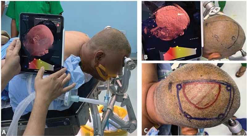 Keyhole Brain Surgery without Neuronavigation: Innovative Usage of Limited Available Resources.