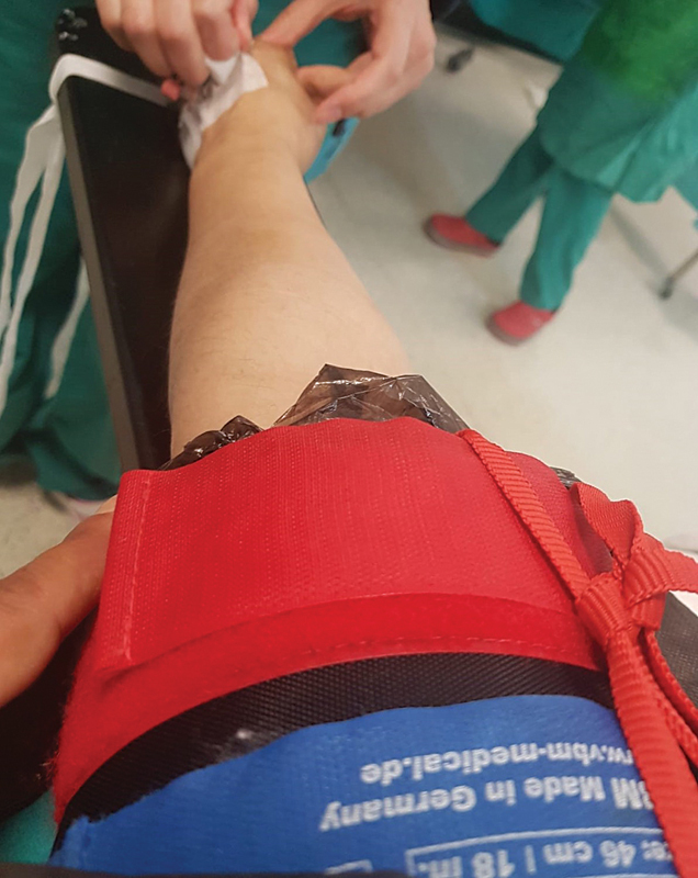 Comparison of Surgical Time and Clinical Outcomes for Intravenous Regional Anesthesia (IVRA) versus Wide-Awake Local Anesthesia No Tourniquet (WALANT) in Open Carpal Tunnel Release Surgery: A Comparative Study.