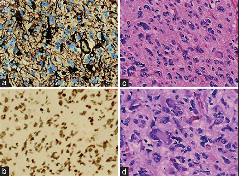 Pleomorphic xanthoastrocytoma with anaplastic features.