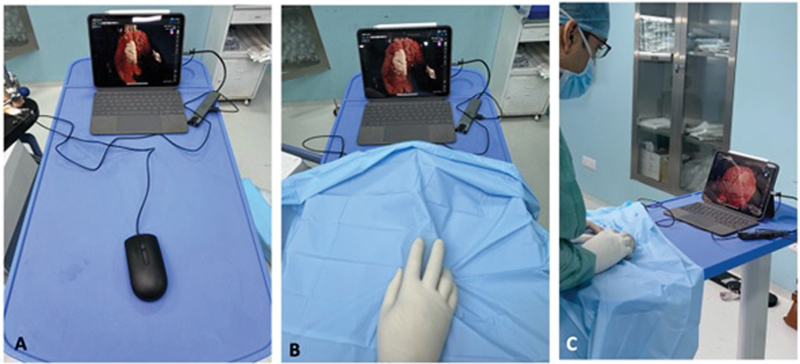 Keyhole Brain Surgery without Neuronavigation: Innovative Usage of Limited Available Resources.