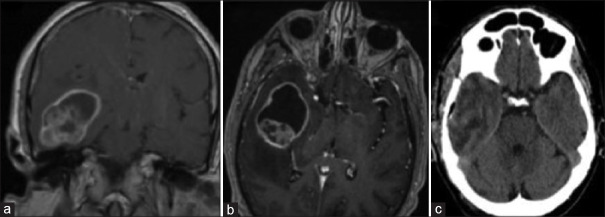 Pleomorphic xanthoastrocytoma with anaplastic features.
