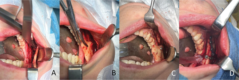 Mandibular Sagittal Split Osteotomy to High Carotid Pathology: Multidisciplinary Management.