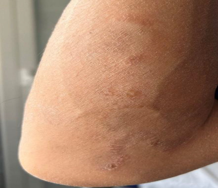 Durable Remission after Allogeneic Hematopoietic Stem Cell Transplantation (Allo-HSCT) for Refractory Mycosis Fungoides: A Case Report.
