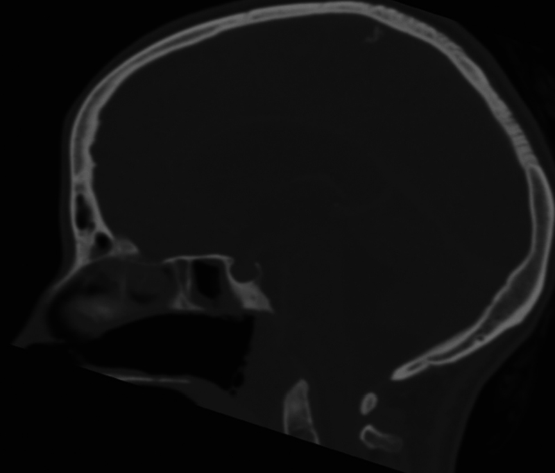 Cocaine-Induced Midline Destructive Lesions-A Harbinger of Meningitis and Hydrocephalus.