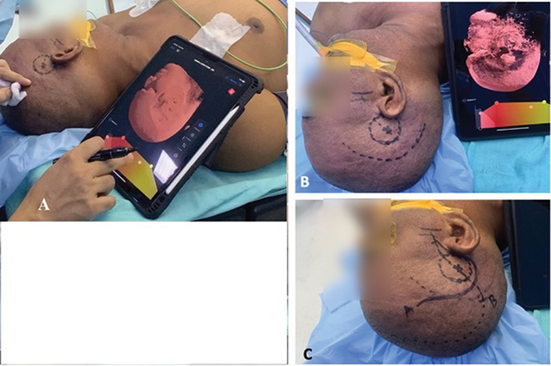 Keyhole Brain Surgery without Neuronavigation: Innovative Usage of Limited Available Resources.