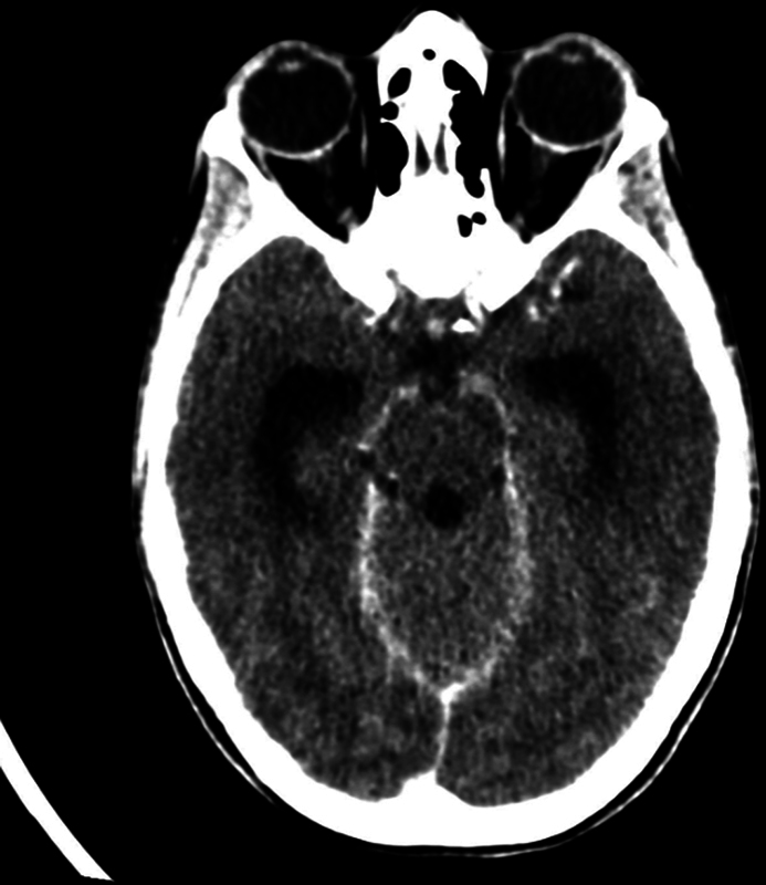 Cocaine-Induced Midline Destructive Lesions-A Harbinger of Meningitis and Hydrocephalus.