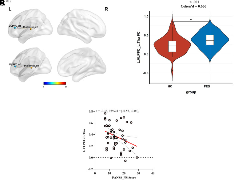 Abnormal Functional Connectivity Pattern of the Reward Circuitry Is Associated with Negative Symptoms and Cognitive Functions in First-Episode Schizophrenia.