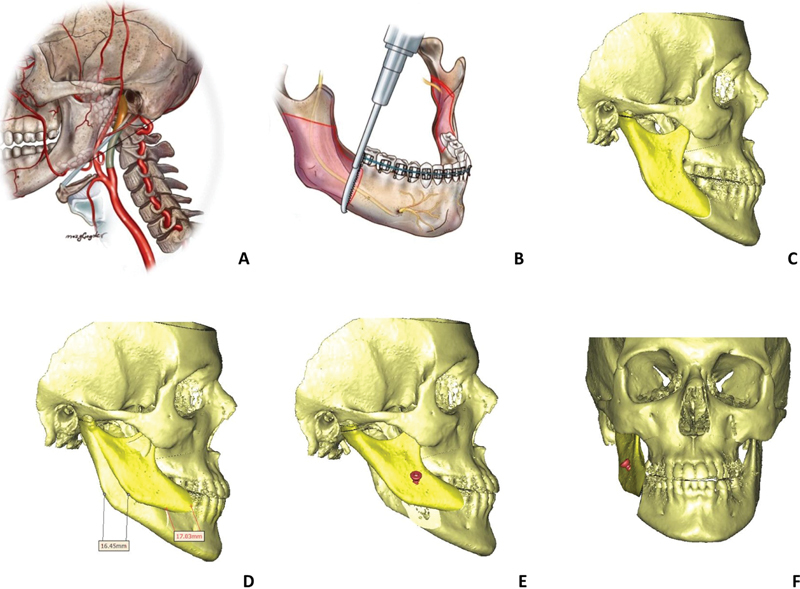 Mandibular Sagittal Split Osteotomy to High Carotid Pathology: Multidisciplinary Management.