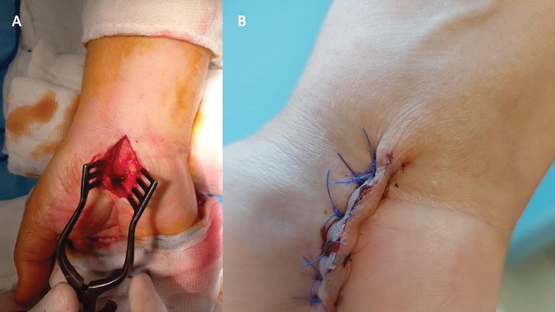Comparison of Surgical Time and Clinical Outcomes for Intravenous Regional Anesthesia (IVRA) versus Wide-Awake Local Anesthesia No Tourniquet (WALANT) in Open Carpal Tunnel Release Surgery: A Comparative Study.