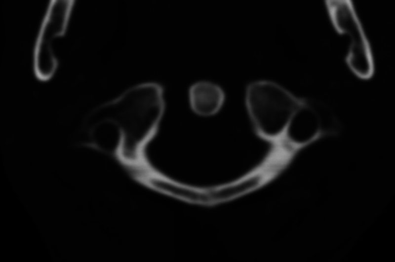 Cocaine-Induced Midline Destructive Lesions-A Harbinger of Meningitis and Hydrocephalus.