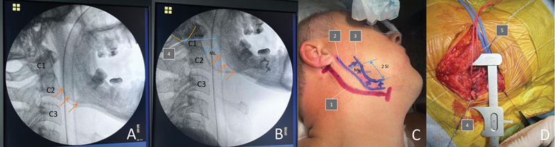 Mandibular Sagittal Split Osteotomy to High Carotid Pathology: Multidisciplinary Management.
