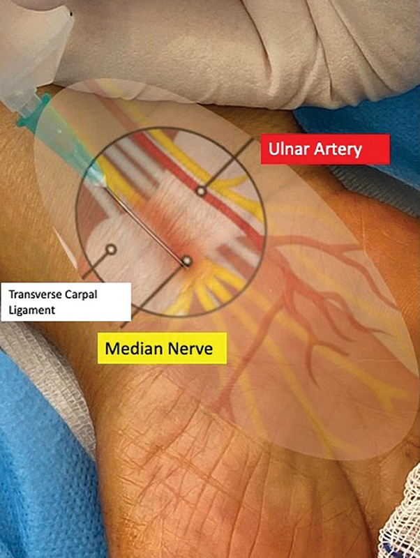 Comparison of Surgical Time and Clinical Outcomes for Intravenous Regional Anesthesia (IVRA) versus Wide-Awake Local Anesthesia No Tourniquet (WALANT) in Open Carpal Tunnel Release Surgery: A Comparative Study.