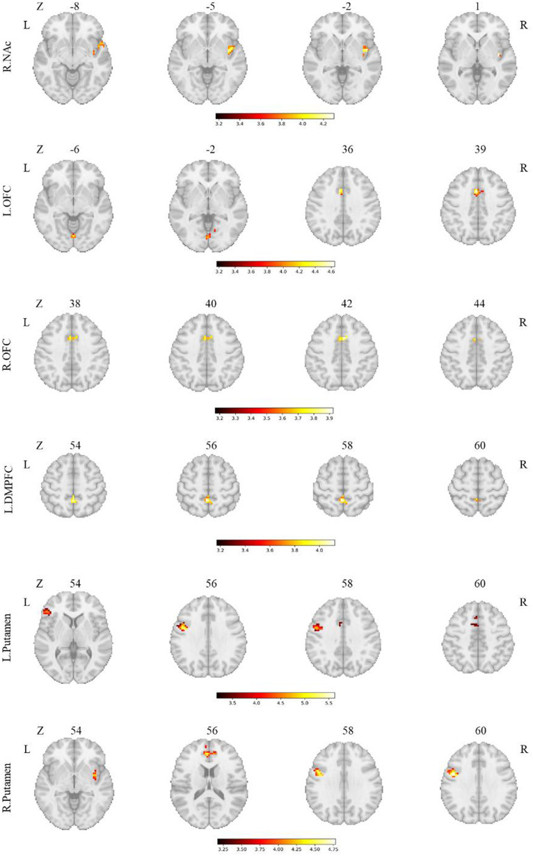 Abnormal Functional Connectivity Pattern of the Reward Circuitry Is Associated with Negative Symptoms and Cognitive Functions in First-Episode Schizophrenia.