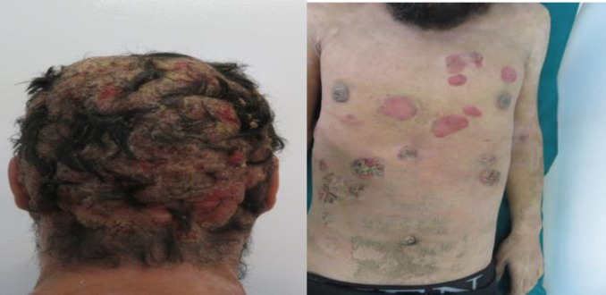 Durable Remission after Allogeneic Hematopoietic Stem Cell Transplantation (Allo-HSCT) for Refractory Mycosis Fungoides: A Case Report.