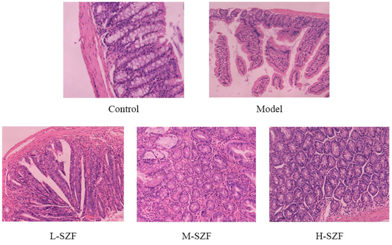 Modulation of Intestinal Barrier Function and Wnt/β- Catenin Pathway by Sanzi Formula in Colorectal Adenoma Development.