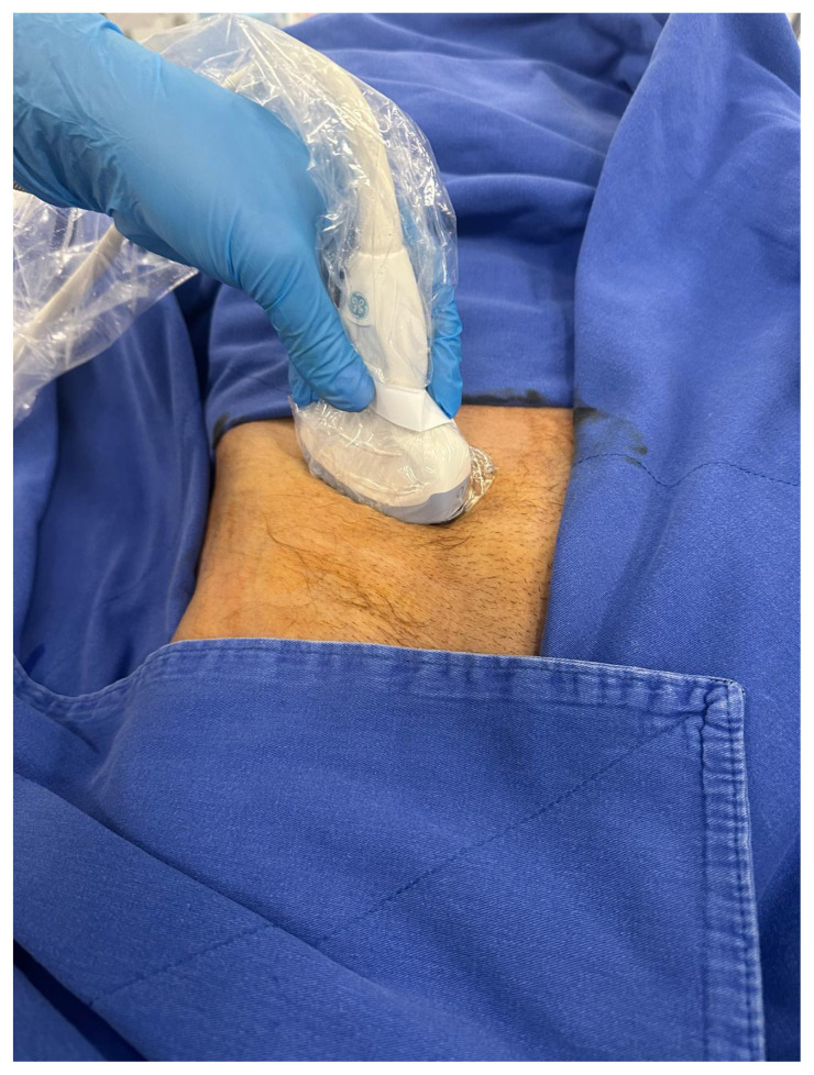 Different local anesthetic volumes in pericapsular nerve group block for hip fracture patients.