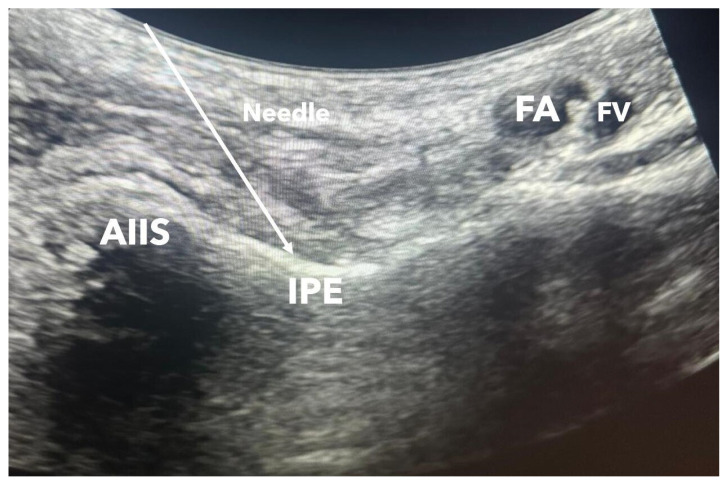 Different local anesthetic volumes in pericapsular nerve group block for hip fracture patients.