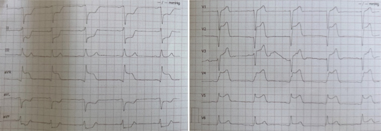 Spontaneous Coronary Artery Dissection and Drug Withdrawal.