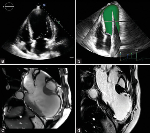 How to Do Echo in a Multimodality Approach to Assess the Risk of Sudden Death: A Consensus Statement of the Italian Society of Echocardiography and Cardiovascular Imaging.