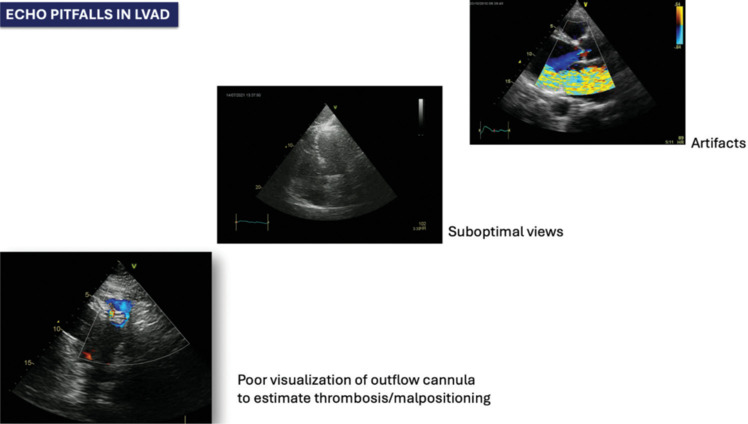 How to Do Echocardiography in Heart Failure Patients with Long-term Left Ventricular Assist Devices: A Consensus Statement of the Italian Society of Echocardiography and Cardiovascular Imaging.