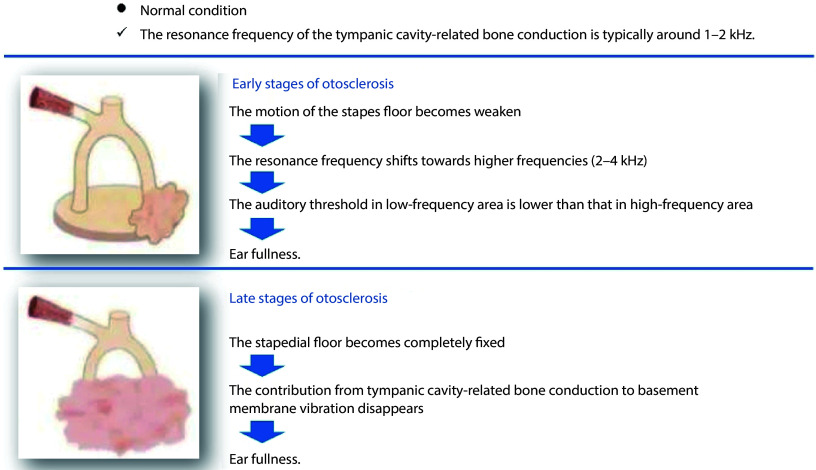 The advancements in understanding the pathogenesis of ear fullness.