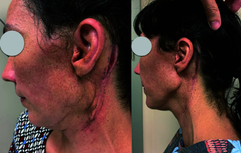 Novel Approach to Osteoradionecrosis of the Temporal Bone: Vascularized Obliteration with Gracilis Muscular Free Flap.
