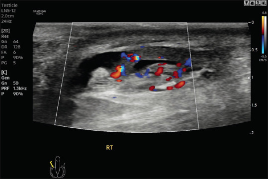 Acute Scrotal Pain - Role of Sonographic Evaluation in Solving Diagnostic Dilemma.