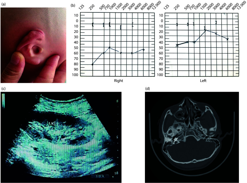 Case report of a novel <i>GREB1L</i> gene mutation in a patient with branchio-oto-renal syndrome.