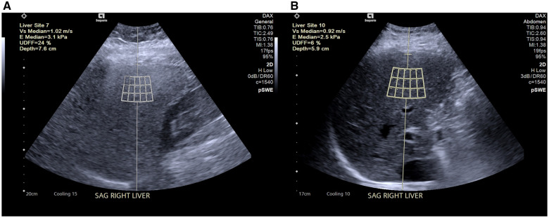 Quantifying changes in steatotic liver disease after bariatric surgery using ultrasound-derived fat fraction.
