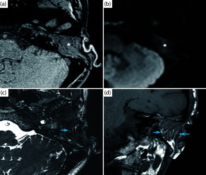 Novel Approach to Osteoradionecrosis of the Temporal Bone: Vascularized Obliteration with Gracilis Muscular Free Flap.