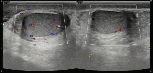 Acute Scrotal Pain - Role of Sonographic Evaluation in Solving Diagnostic Dilemma.