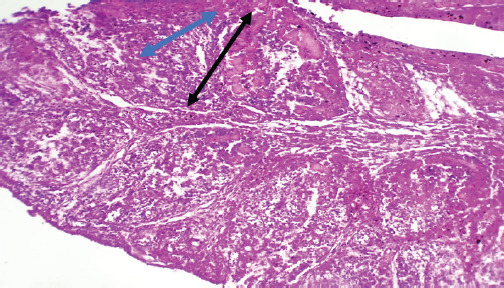 A novel reassortant strain of the infectious bursal disease virus (IBDV ASPVB) from Iraqi broiler farms: A first-time molecular and histopathological investigation revealing new insights.
