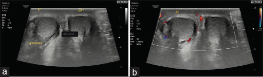 Acute Scrotal Pain - Role of Sonographic Evaluation in Solving Diagnostic Dilemma.